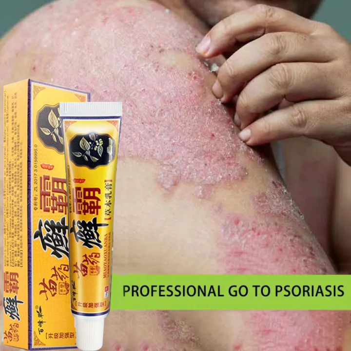 eczema treatment cream Gamot Sa Kati Kati Atoderma Cream Original Gamot ...