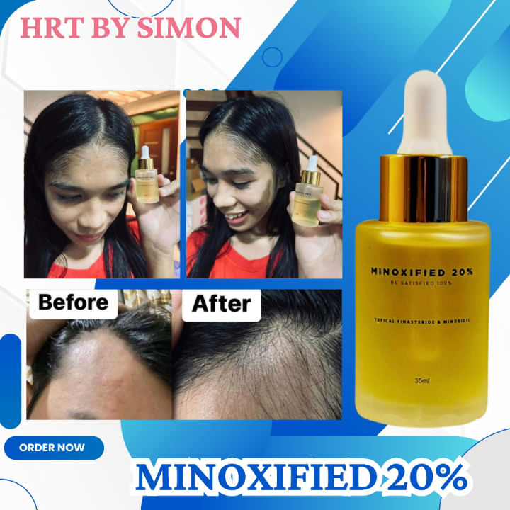 MINOXIFIED 20 hair growth 20 Minoxidil Minox Hair Grower Treatment ...