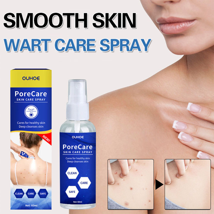 Skin care spray to lighten moles smooth skin and eliminate warts
