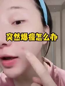 【Ship in 24H】【现货】祛痘精华液去痘印痘坑痘疤去痘粉刺淡化水杨酸修复 Big Water Drops 3 Points Acne Removal Essence Remove Marks Pit Scars Diminish Salicylic Acid Repair