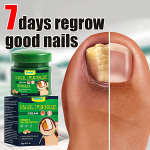 new 20g Nail Fungus Treatment Cream Finger Toe Nail Fungal Removal Plant Extraction Anti Infection Paronychia Onychomycosis Care hot