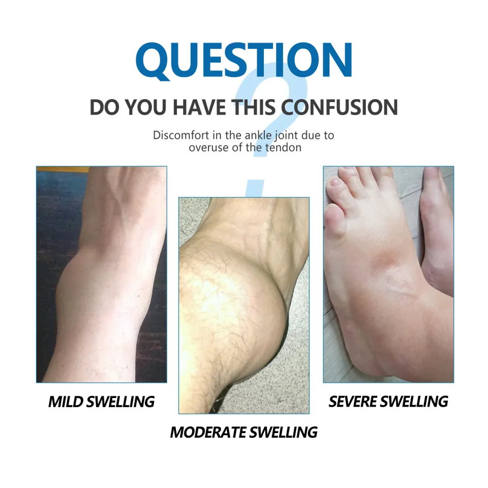 Arthritis Sole Heel Pain Big Toe Pain And Stiffness MTP Joint