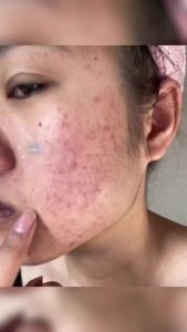 Acne treatment Facial Cleanser Whitening Facial Cleanse 100g Effective Oil control Moisturize Anti Pimple deep cleansing