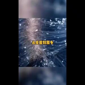 屑康王止痒去屑头皮油螨修护洗发膏洗发水清爽头油净螨头藓头痒白