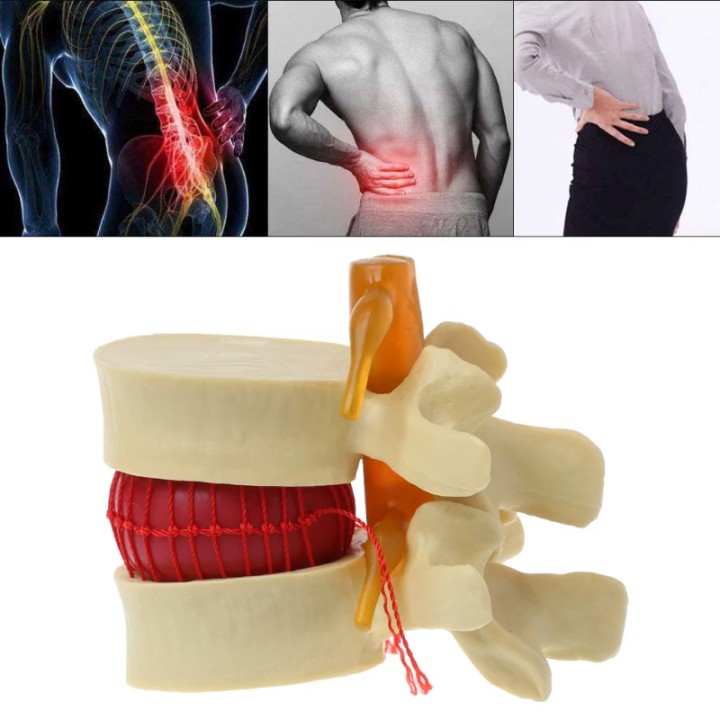 PVC Human Lumbar Model Anatomical  Disc Herniation Medical Learn Aid Instrume Teaching Training Aid Education