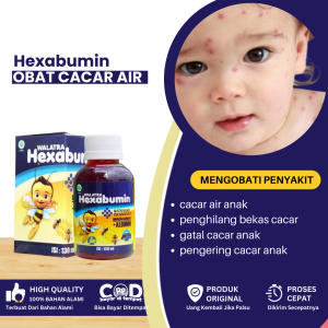 Obat Cacar Air Anak Penghilang Bekas Luka Cacar Obat Cacar Air Bernanah Obat Penghilang Gatal Cacar Anak Penghilang Cacar Api Anak Obat Cacar Berair Anak Obat Pengering Cacar Air Obat Cacar Air Gatal Perih Ruam Kulit Anak - Walatra Hexabumin