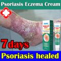 Psoriasis Eczema Cream Anti-itching Antibacterial Atoderma Ointment Herbal Dermatitis Cream 20g Eczema Treatment Cream gamot sa kati kati sa balat buni Psoriasis Treatment Cream Eczema Ointment for Itchy Skin and Allergy Antibacterial Fungisol Antifungal. 