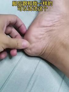 脚后跟干裂修复霜龟裂开裂皲裂手足治防裂脱皮膏去死皮润起皮神器