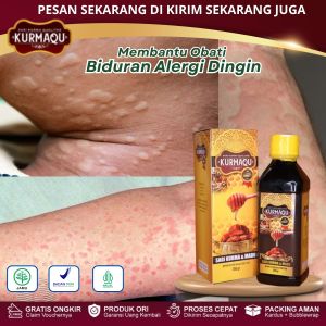 Obat Biduran Alergi Dingin Bentol Bentol Di Badan Biduran Di Seluruh Badan Gatal Berair Bintik Merah Urtikaria Akut Hives Atasi Kaligata Dengan KURMAQU GMJ