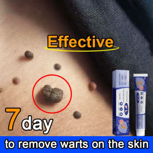 Obat Kutil paling ampuh Wart Remover Skin Tag Remover Wart Ointment Penghilang TahiLalat dan Kutil Mata Ikan