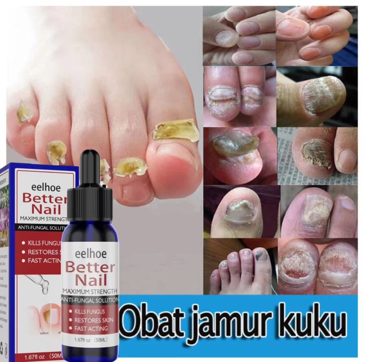 New Anti Fungal Nail Treatment Finger Toe Nail Fungus Onychomycosis Remover  | eBay
