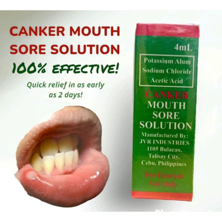 CANKER MOUTH SORE SOLUTION GAMUT SA SINGAW | Lazada PH