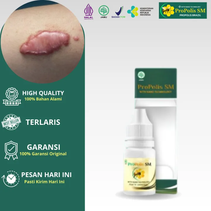 Bekas Caesar Rapi Propolis SM Obat Keloid, Keloid Menahun, Daging Jadi, Daging Tumbuh ...