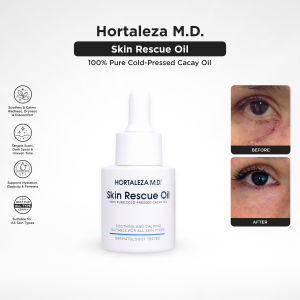 Hortaleza M.D. Skin Rescue Oil – Cacay Retinol Face Oil for Dark Spots | Redness & Sensitive Skin | Fast-absorbing formula with Vitamin E & Squalene helps repair dry skin | Acne marks & uneven tone for healthy glowing skin | Improve skin texture