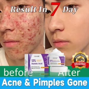 OUHOE Azelaic Acid Acne Care Face Cream Gentle Moisturizing Improve Facial Acne Brighten Hydrating Skin Care Cream Smooth Skin Repairing Facial Treatment Non-Greasy Fast Absorbing Daily Face Moisturizer for Clearer Healthier Skin