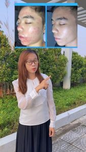 Skinoren Cream (Azelaic Acid 20%) for Acne & Hyperpigmentation 30g