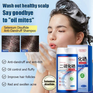 Selenium Disulfide Anti Dandruff Shampoo Psoriasis Shampoo For Itchy Scalp Hair Treatment 150ml