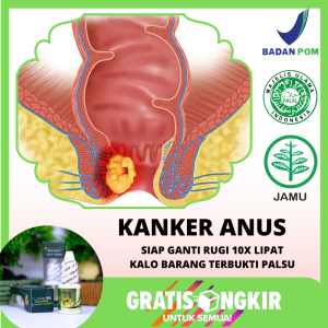 Obat Kanker Anus Kangker Stadium 1 2 3 4 Penghilang Benjolan Di Bibir Anus Kanan Kiri Tonjolan Pada Bokong Pantat Tulang Ekor Salep Pengempis Kelenjar Getah Bening Anus Abses Bernanah Bisul Bengkak Pendarahan Dubur Wasir Dan Ambeien - Propolis Sm