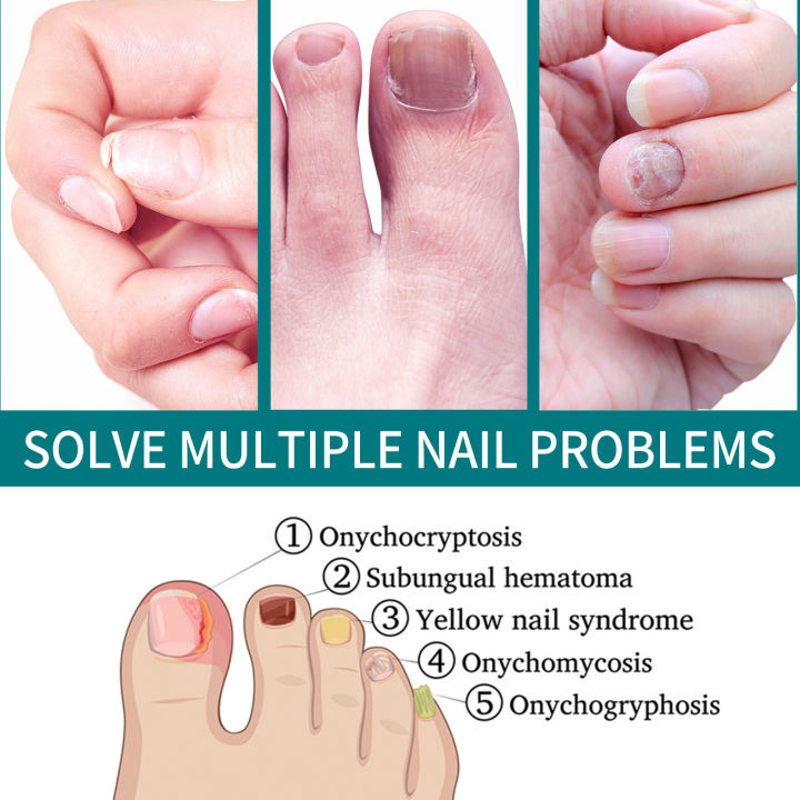 %E3%80%90100%25%20Effective%E3%80%91Jaysuing%20Fungal%20Nail%20Treatment%20Patch%20Anti%20Infection%20Paronychia%20Thickening%20Soft%20Waterproof%2032pcs%20-%20Image%209