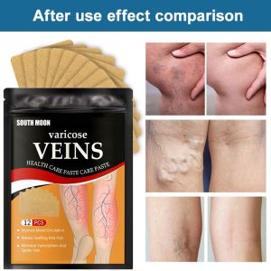 ALLinALL.mart 12PCS Varicose Veins Plaster Spider Leg Medical Patch Angiitis Removal Patch