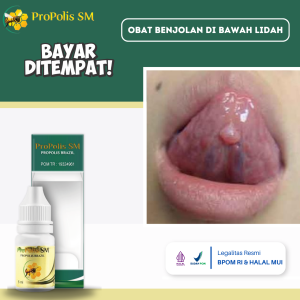 Obat Benjolan Di Lidah Obat Benjolan Di Bawah Lidah Obat Benjolan Dilidah Anak Dan Dewasa Obat Kelenjar Air Liur Obat Lidah Bengkak Radang Lidah Mati Rasa Obat Benjolan Langit Mulut Dengan Propolis SM