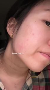 Azelaic ical Acid 12% Serum for Face – Dark Spot Remover with Tranexamic Acid Salicylic Acid Niacinamide & Centella Asiatica – Acne Hyperpigmentation & Rosacea ment 1 Oz Korean Skincare