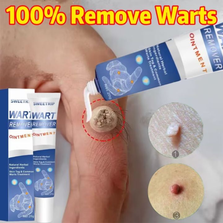 warts remover cream original painless 20g Warts Magic Remover Wartz Removal Cream Warts Remover Skin Kulugo Remover Skin Growth Warts Remover Mole And Warts Remover warts remover cream ointment warts remover original