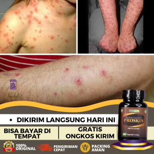 Obat Darah Manis Obat Herbal Prurigo Obat Gatal Darah Manis Obat Infeksi Darah Manis Obat Gatal Kulit Darah Manis Obat Penghilang Bekas Luka Gatal Darah Manis Obat Kulit Gatal Merah Obat Bintik-Bintik Merah Obat Darah Manis Prurigo Dengan Proskin