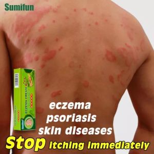 Effective Sumifun Eczema Treatment Cream gamot sa kati kati sa balat buni Psoriasis Treatment Cream Ointment for Itchy Skin and Allergy Antibacterial Fungisol Antifungal Cream Anti Itch Cream for Skin Herbal Cream fungisol antifungal (20g)