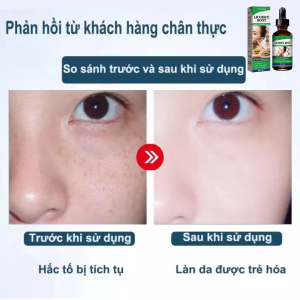 Tinh chất đánh bay mụn nám Jaysuing 30ml giúp tái tạo da mặt làm sáng và căng bóng da ngăn ngừa lão hóa dachống thâm mắt và bọng mắt một cách hiệu quả Tinh chất chống lão hóa chống nhăn căng bóng da ngừa nám tàn nhang