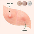 Super Plester Jerawat Acne Pimple Patch 36 PCS Obat Jerawat Wajah. 