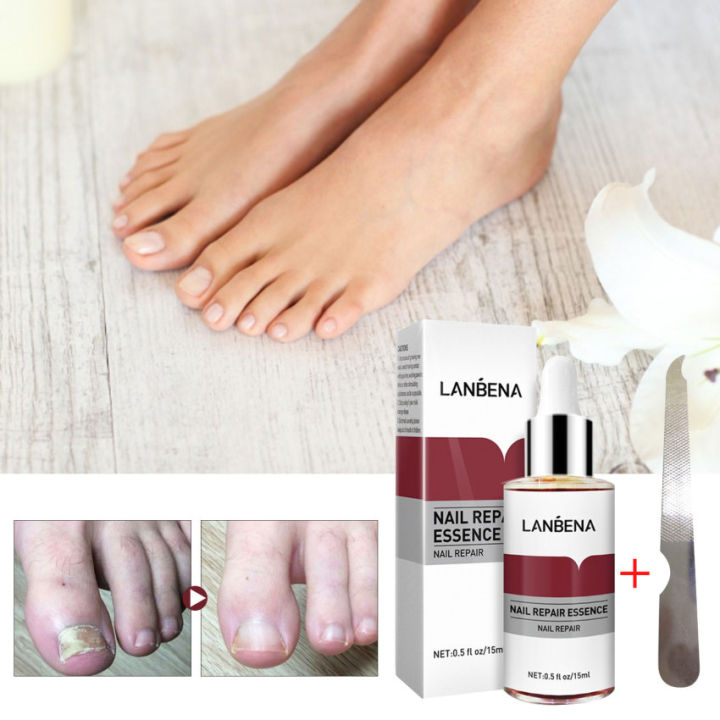 LANBENA Nail Repair Essence Fungal Nail Treatment Serum Removal