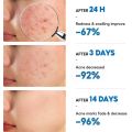 GL.25g Pimple Remover Cream Acne Removal Scar Marks Cream Acne Treatment Skin Cream Effective Anti-acne. 