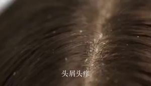 Anti dandruff shampoo Syampoo kelemumur dan gatal kepala Oil control and anti-itch shampoo 500ML 頭皮屑 洗發水Minyak Kawal Kelemumur Hilang