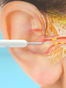 MDK Smart Visual Ear Cleaner with Camera 1080P 500W HD Endoscope WIFI Ear Pick Stick for Baby Ear Wax Removal Tool with 6 LED Lights