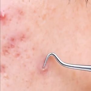5In1 Stainless Steel Blackhead Remover Tool Kit Acne Pimple Comedone Extractor Facial Pore Cleaning Tool 粉刺黑头清洁针