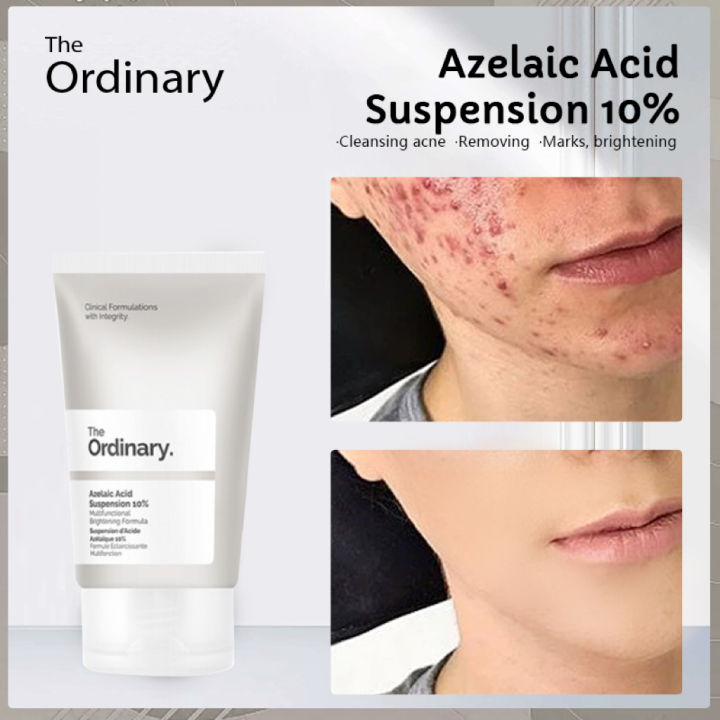 the ordinary azelaic acid suspention 10 azelaic acid cream