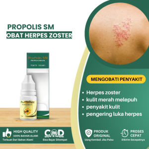 Obat Oles Herpes Zoster Obat Oles Herpes Kulit Obat Kulit Merah Melepuh Obat Kulit Merah Melepuh Obat Herpes Di Perut Obat Penyakit Kulit Obat Kulit Merah Melepuh Obat Herpes Di Kelamin Herpes Genital - Propolis SM