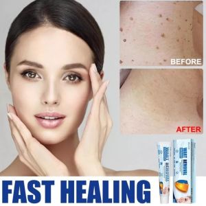 [Loại Xịn] Serum gel tẩy nốt ruồi xóa mụn ruồi trên mặt tàn nhang mụn cóc mụn thịt  mụn cơm mắt cá tại nhà an toàn và gel mờ sẹo Kem ngăn sẹo nga kem ngừa sẹo lồi thâm sẹo rỗ lâu năm các loại sẹo mụn.TRÂU REMOVE EVER