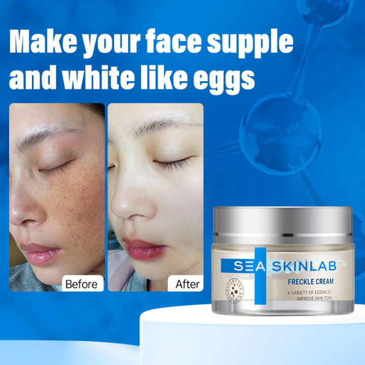 Pigmentation Removal Cream Black Spot Face Melasma Removal Skin
