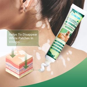 SUMIFUN Krim Bintik Putih Untuk Vitiligo Leukoplakia Pigmentasi White Spot Vitiligo Treament Cream Antibacterial Cream Skin Rash Cream Psoriasis Localized Vitiligo Ointment Mycosis Leukoplakia Treatment 20g
