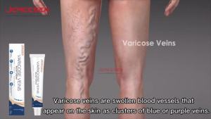 Jemeesen Varicose Veins Cream Hilangkan Urat Bengkak Spider Veins Treatment for Legs Improve Circulation