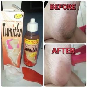 Tumitku Obat Kaki Pecah2 Bpom 30 ml Solusi Tumit Kapalan Kering Dan Pecah