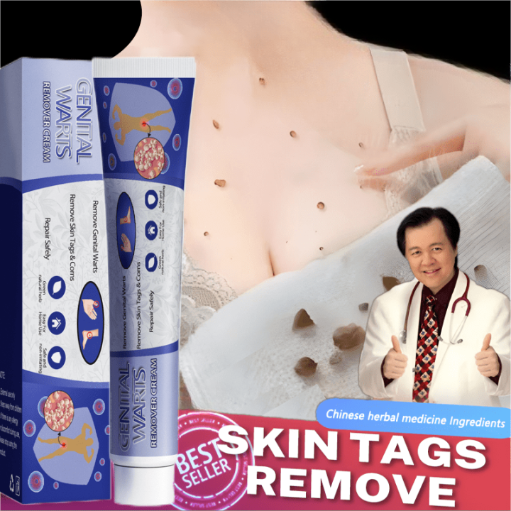 Wart Cream Mole Remover Cream Warts Remover Original Cream Warts Skin Tags Remover Tahi Lalat