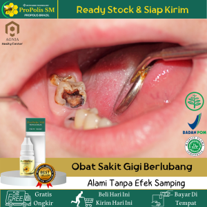 Obat Sakit Gigi Berlubang Obat Sakit Gigi Dan Gusi Obat Linu Di Gigi Obat Abses Gigi Obat Herbal Sakit Gigi Obat Tetes Sakit Gigi Obat Penghilang Bau Mulut Atasi Dengan Propolis SM 100% Original - Herbal Alami Tanpa Efek Samping