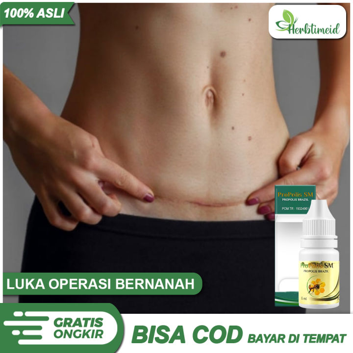 Bekas Caesar Rapi Obat Luka Caesar Bernanah dan Berlubang - Luka Bekas Operasi Keluar ...