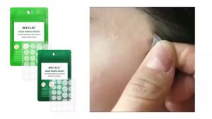 Brelley Tea Tree Acne Patch LANBENA Invisible Breathable Acne Patch Facial Acne Treatment