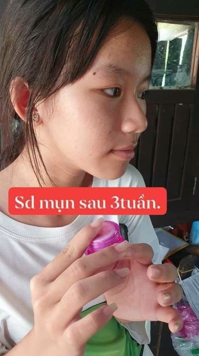 Combo%205%20H%E1%BB%99p%20Kem%20M%E1%BB%A5n%202C%20-%20Image%203