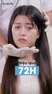 Chấm Mụn Acnecin Giúp Xẹp Mụn Sau 8H Thông Thoáng Lỗ Chân Lông Sáng Da 19 Gram. - giúp da trở nên mịn màng và sáng bóng hơn. Đồng thời nó còn giúp tăng độ đàn hồi cho da giúp da trở nên săn chắc và tràn đầy sức sống