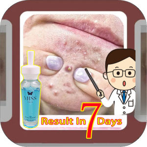 BPOM MISS YOUTH Serum Acne Ampuh Mengatasi Jerawat Dan Bekas Jerawat Cream Jerawat Face Skin Care/penghilang bekas jerawat pria-obat jerawat paling ampuh dan cepat-Memperbaiki pori-pori menghidrasi dan melembabkan-acne serum penghilang jerawat